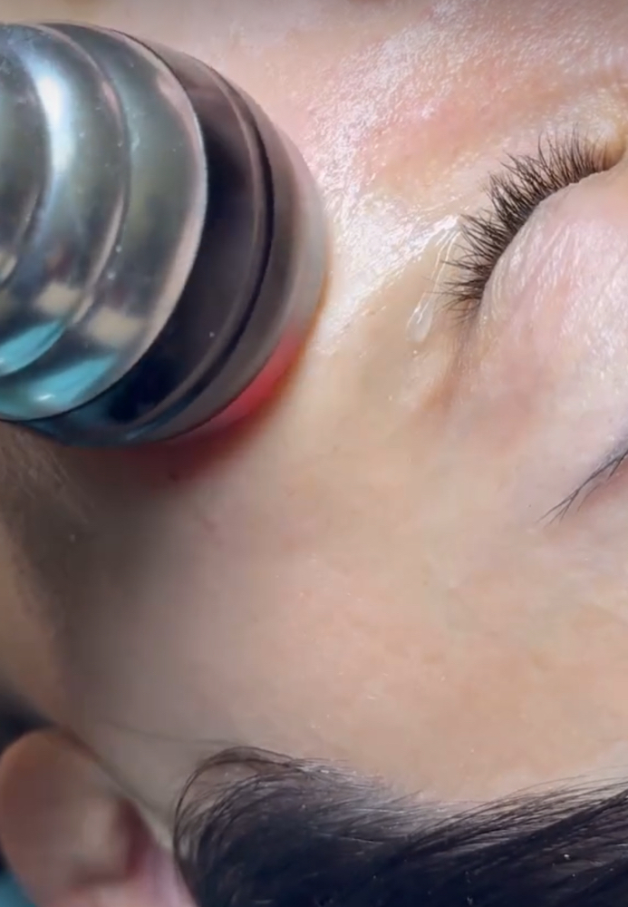 The Radio Freqency  Treatment