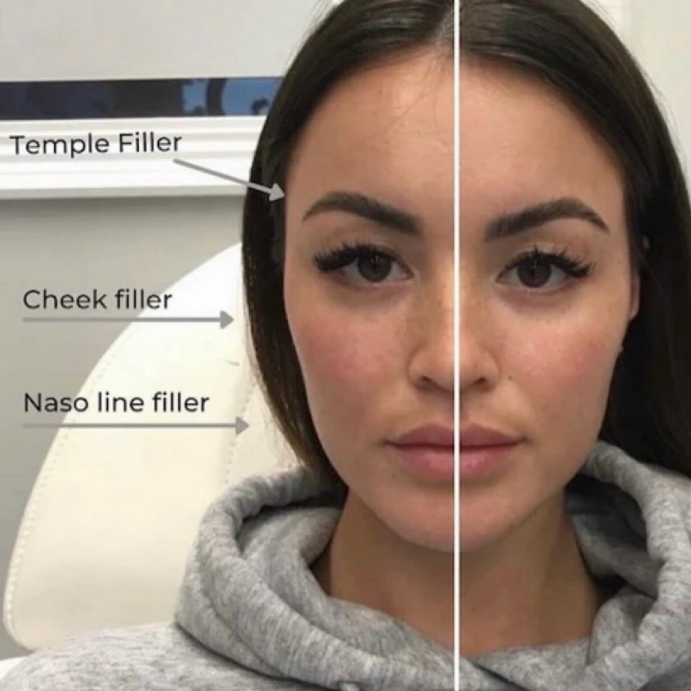 Filler Face Balance at Gold Stone Beauty in mcallen, TX