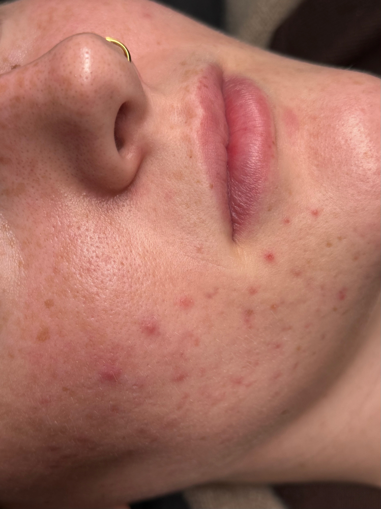 the acne bootcamp consultation at Butler Skin in Sheridan, WY