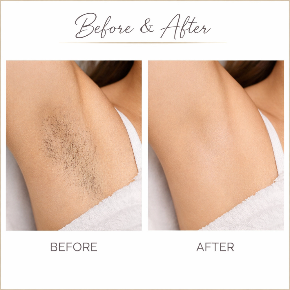 Underarms at OC Aesthetics Lounge in Lake Forest, CA