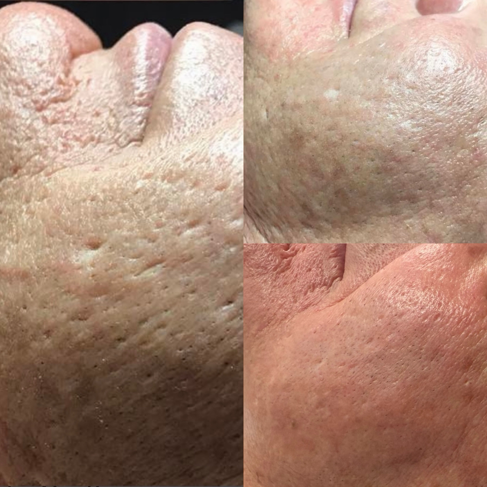 Acne Scar Reduction Treatment at Stacey Carta Skin Care in Concord, CA