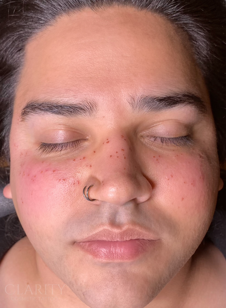 Light coverage freckles