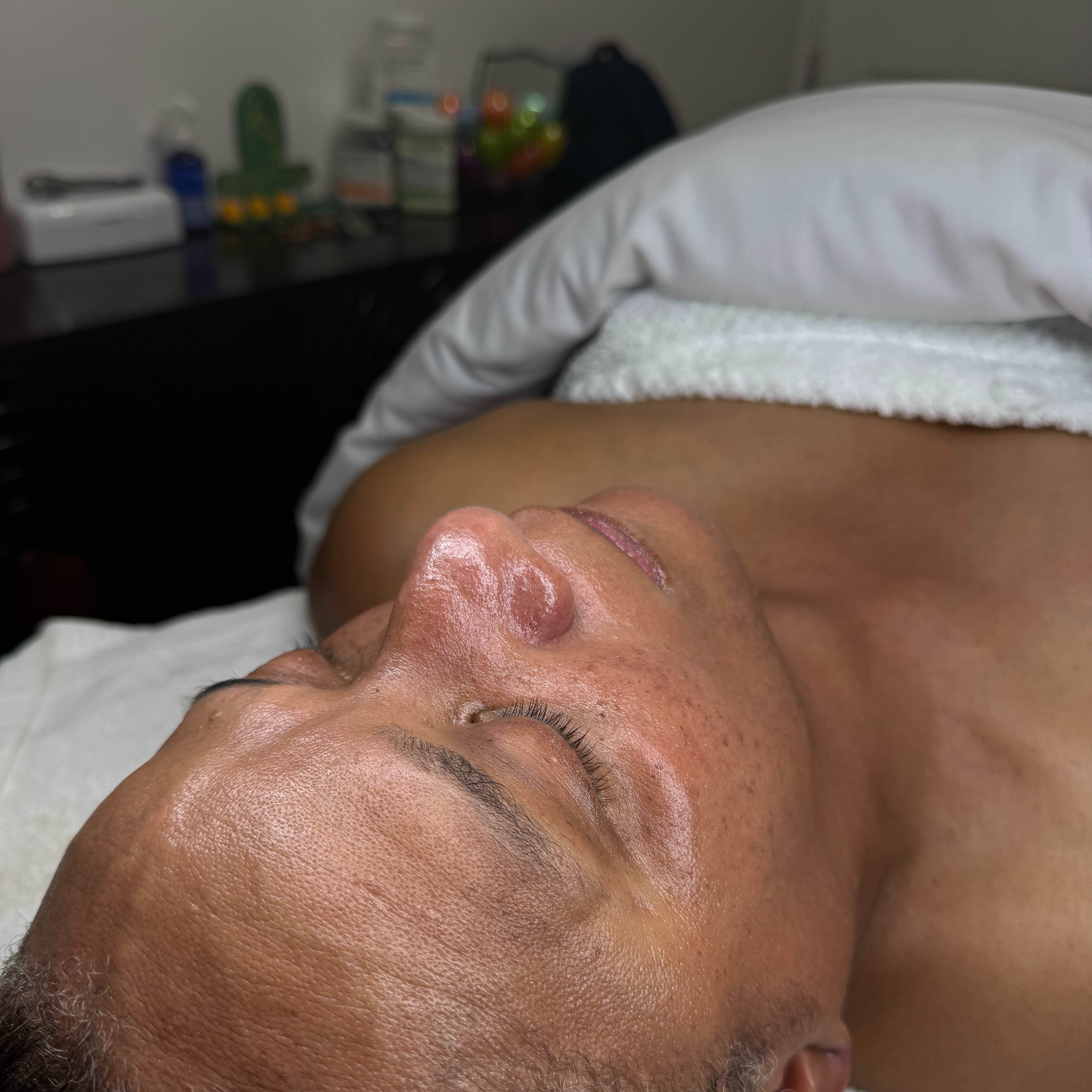 Herbal Peel Recovery Treatment at Velnaira in Lakewood, CA