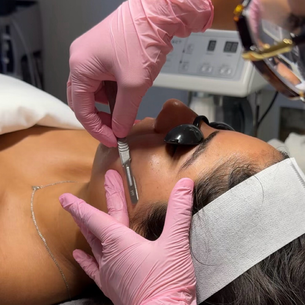 DERMAPLANE (NO EXTRACTIONS) at Czerinaesthetics, LLC in San Antonio, TX