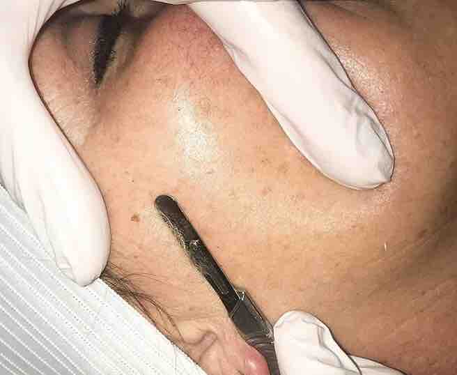 Dermaplaning