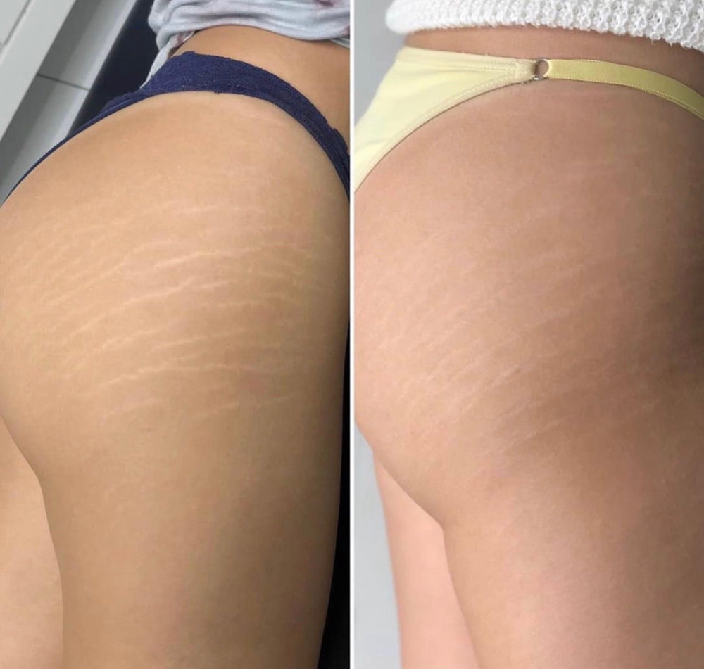 Stretch mark Or Scar Camouflage