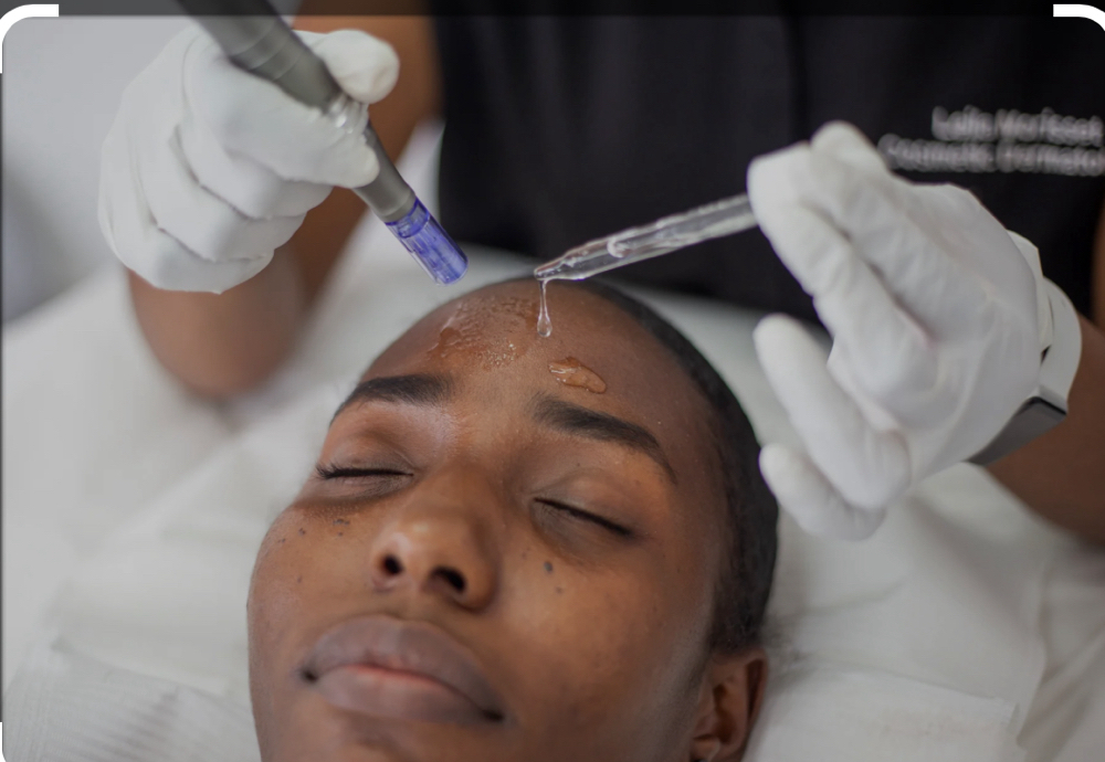 MicroNeedling