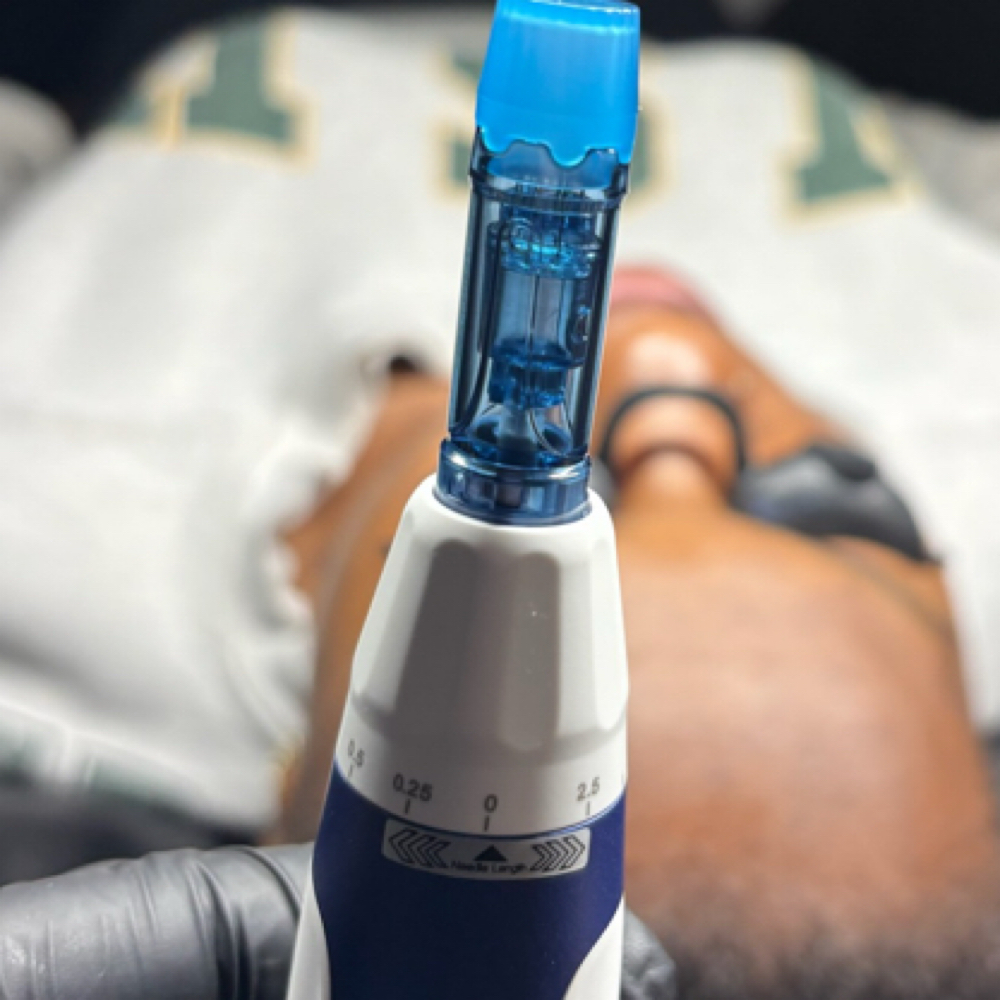 Consult - Microneedling at ALL GLOWN UP SKINCARE in Temple Hills, MD