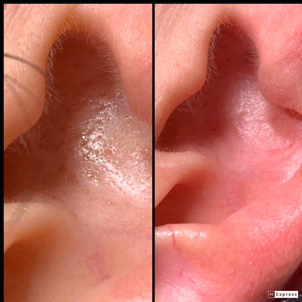 Deep Pore EAR treatment