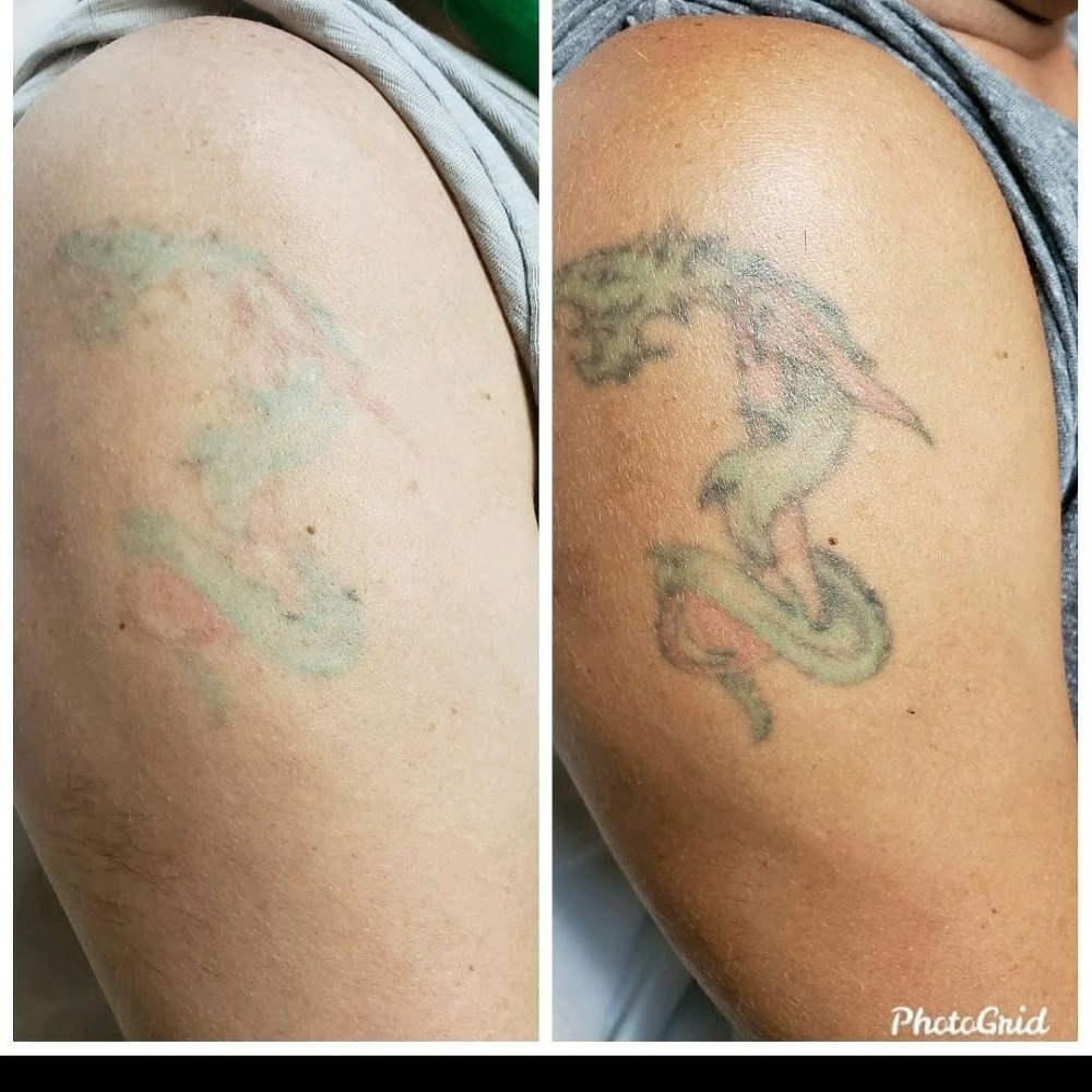 Laser Tattoo Removal