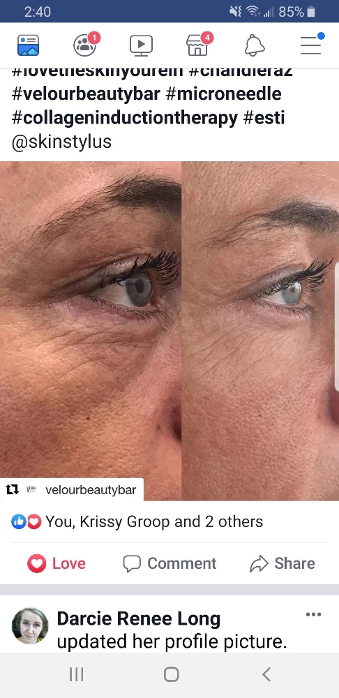 Wrinkle Reduction