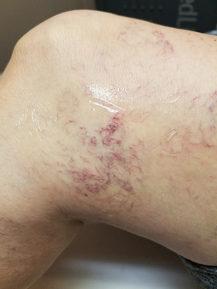 Spider Vein Treatments