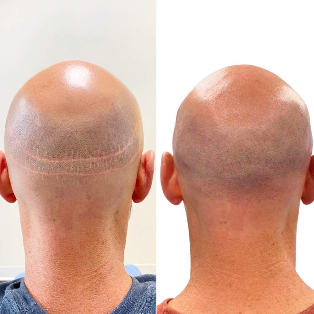 Scalp Micropigmentation