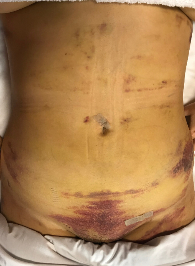 Post-Op Lymphatic (Prepaid)