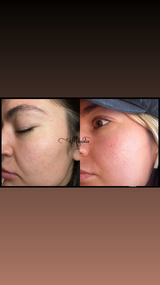 Cheek Lift