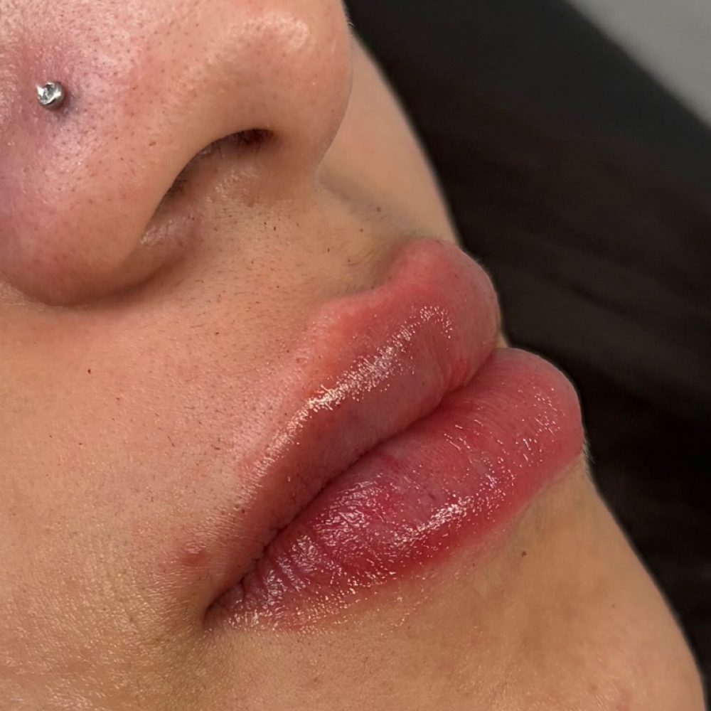 0.5ml Filler at Punchy Pouts & Esthetics in Amarillo, TX