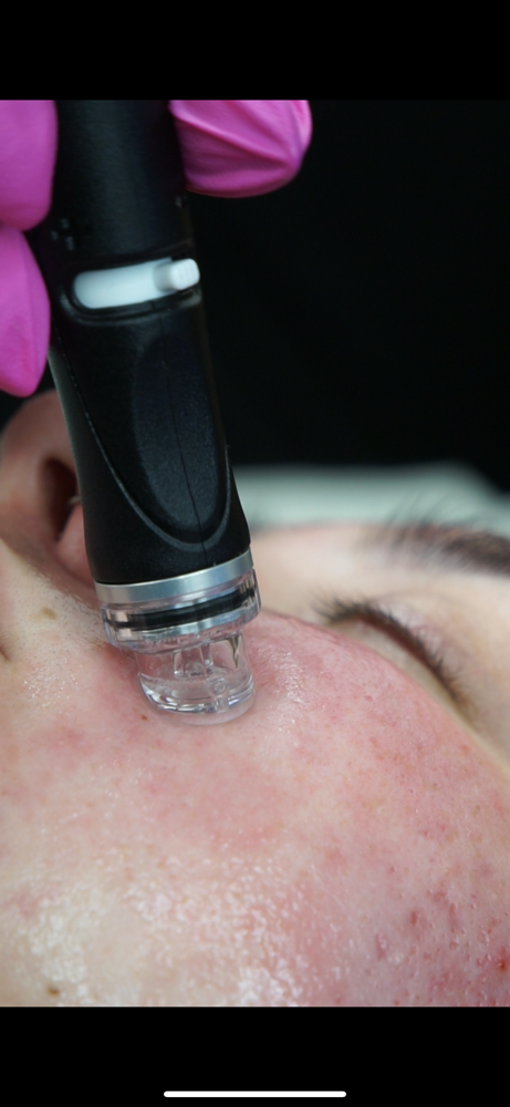 Hydrafacial: Glow & Sculpt