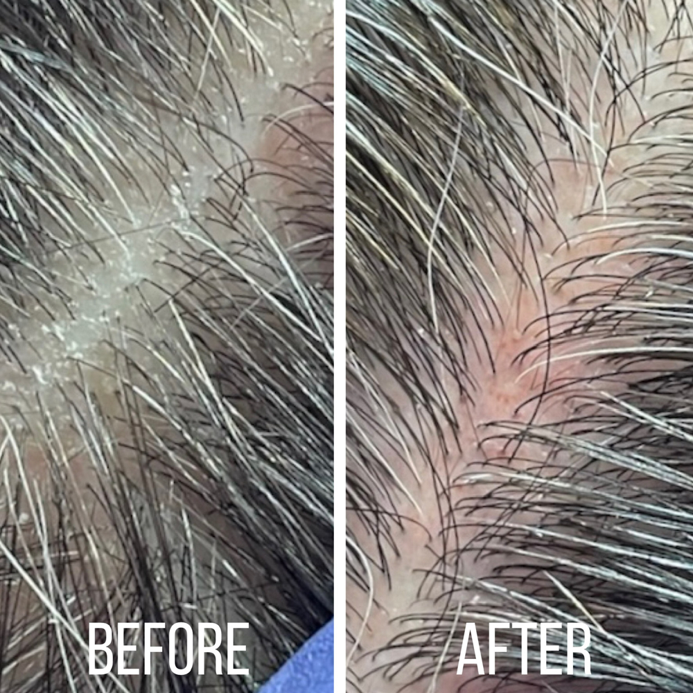 Scalp Deep Cleanse (Hydrafacial)