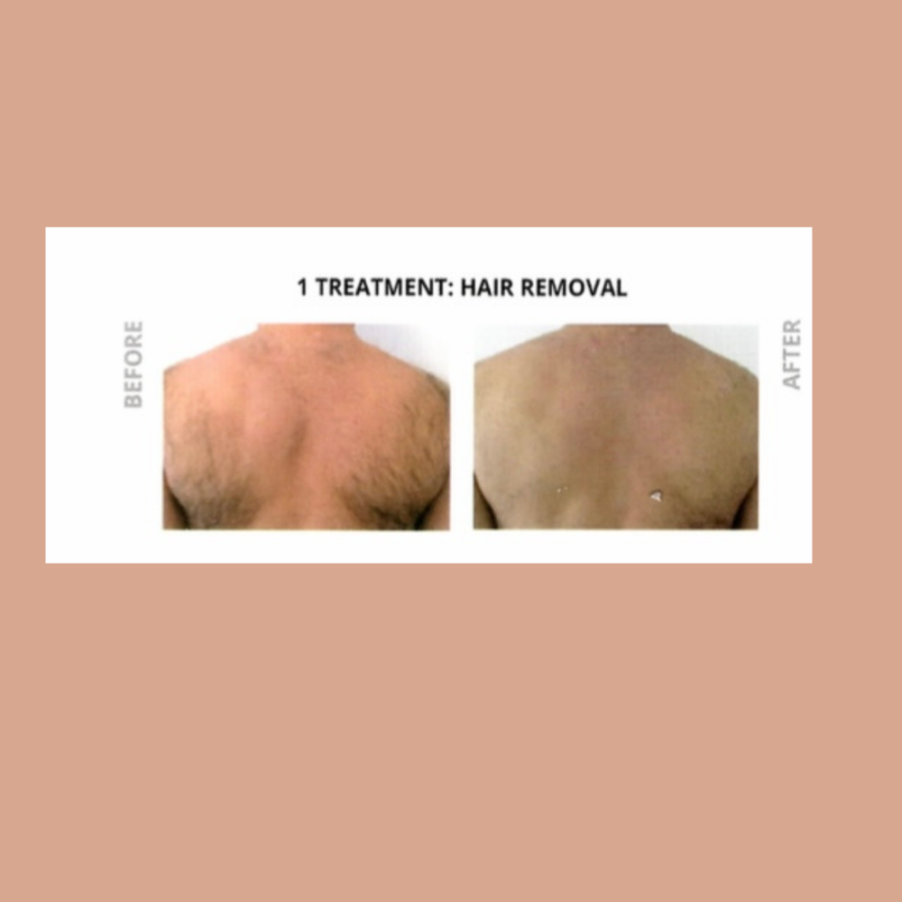 Laser Hair Removal- Full Back