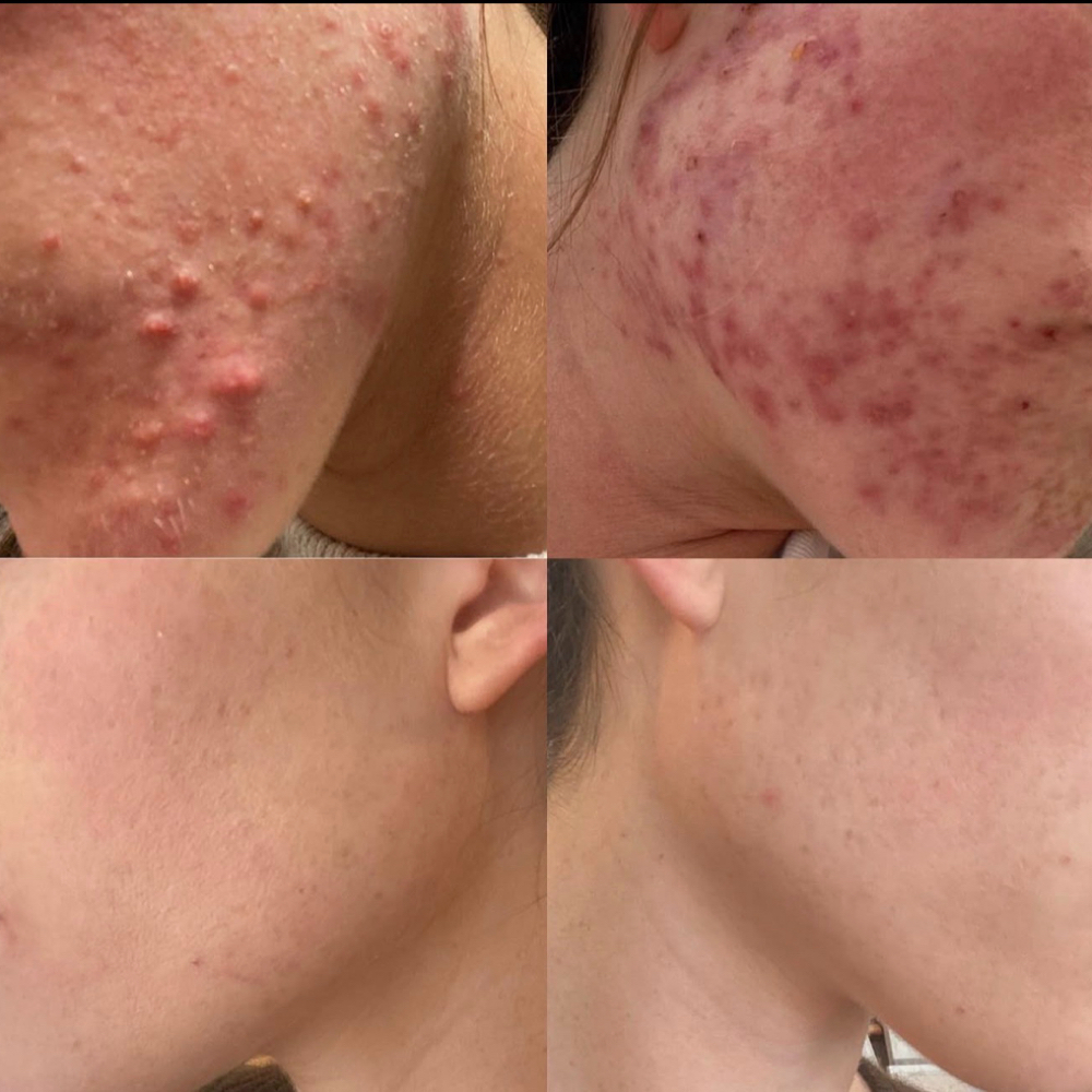 Face Reality-Acne Consult+Treatment at The Holy Facialist in San Diego, CA