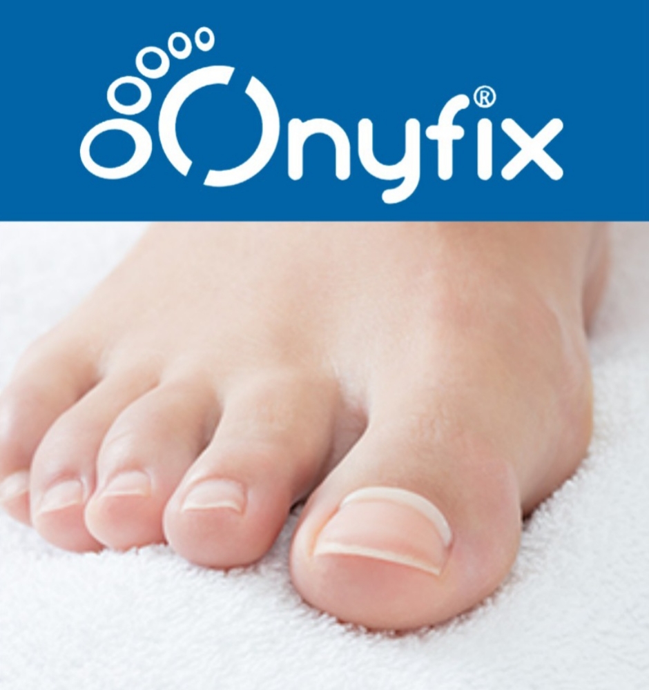 Onyfix Toenail Correction