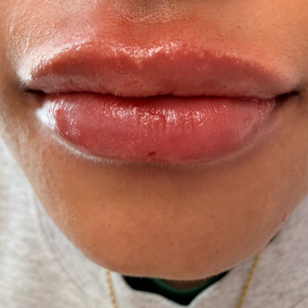 Lip Filler at Janeth García in tx, TX