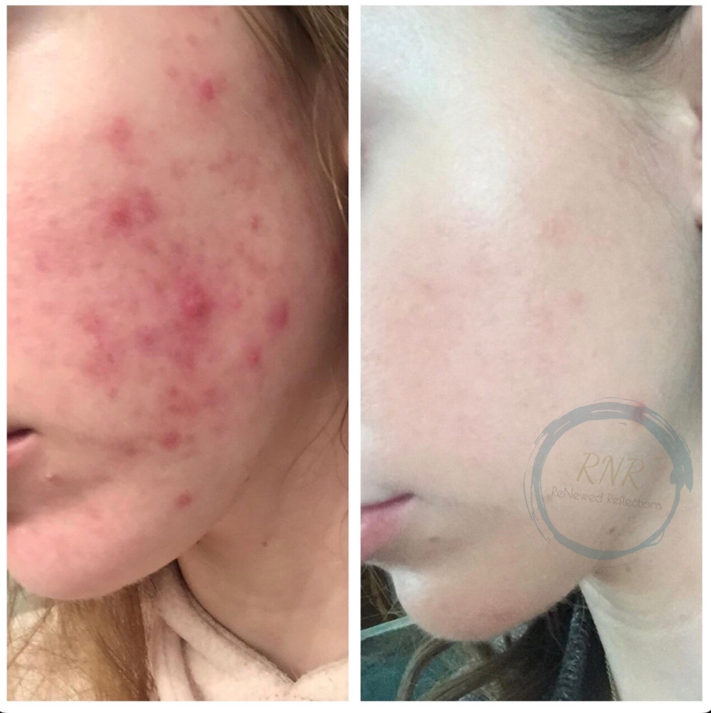 Acne Relief Program