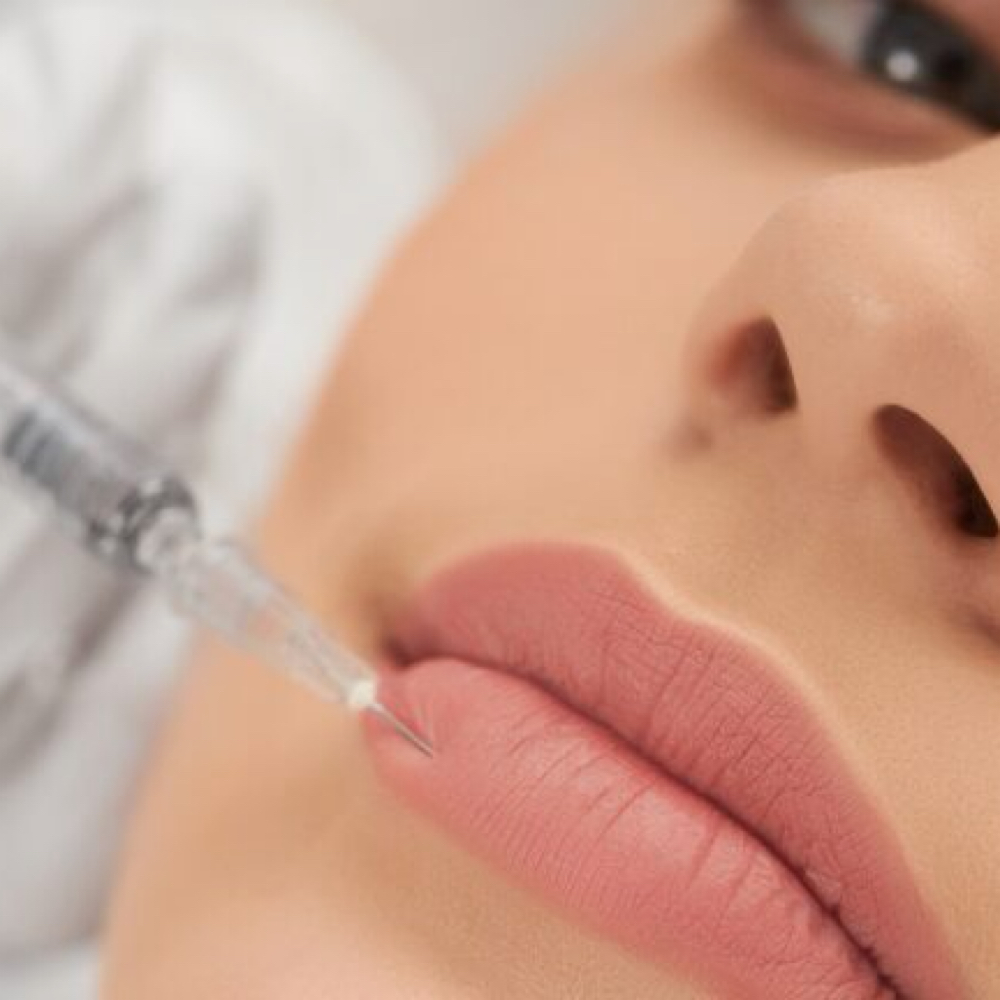 Lip fillers 1/2 Syringe at Elevate RN Aesthetics in Mcallen, TX