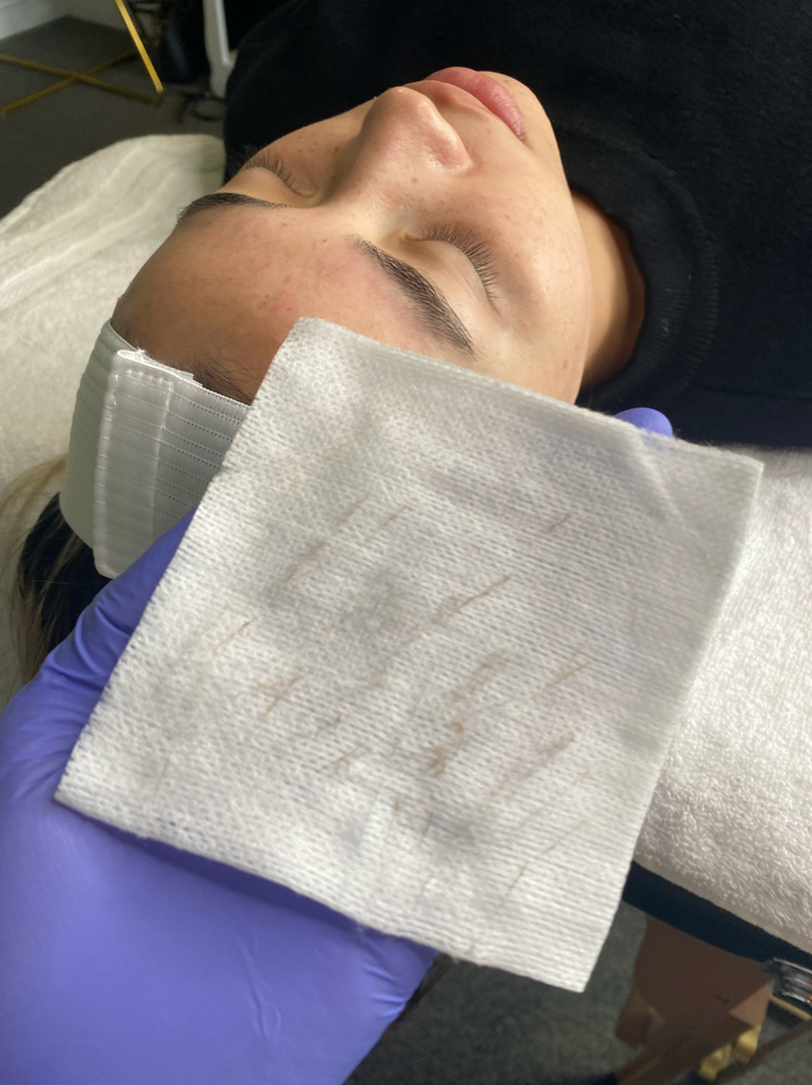 DERMAPLANING FACIAL