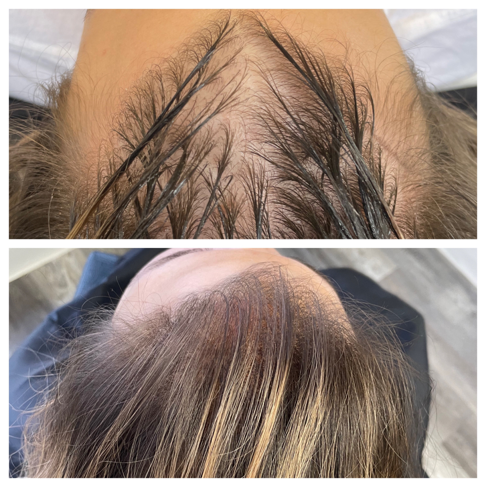 Scalp Microblading