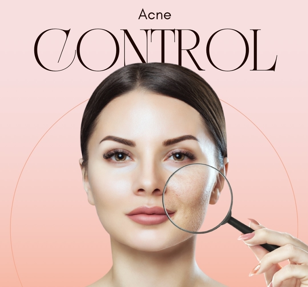 Acne Treatment Package