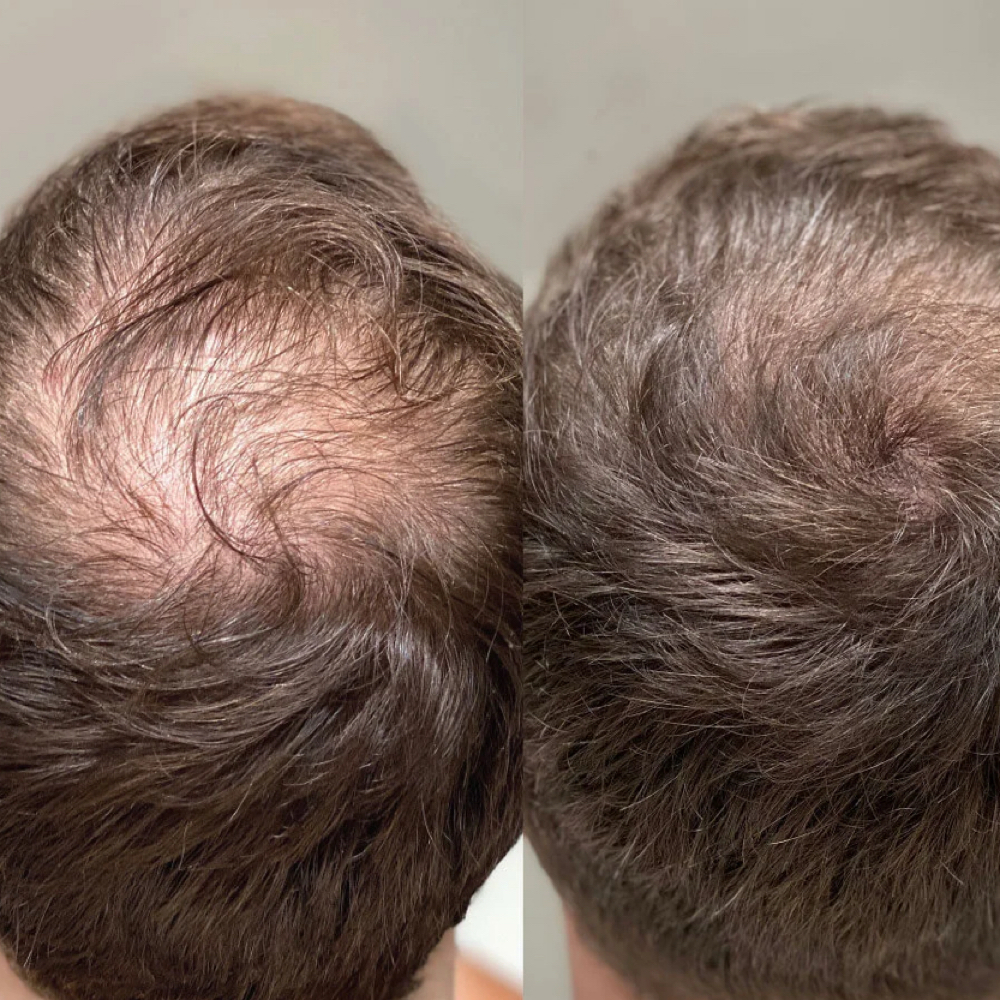 PRP-PRF Hair Restoration at The Utah Spa and Wellness Center in Provo, UT