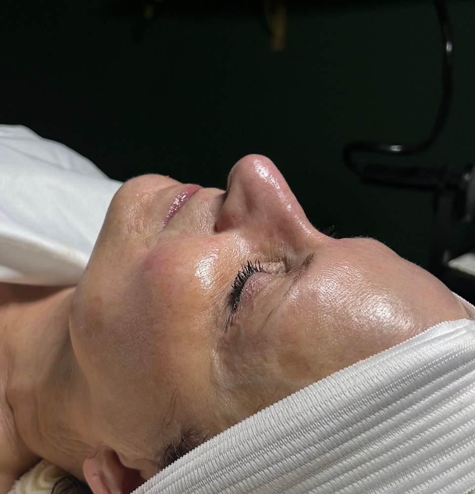 Chemical Peel