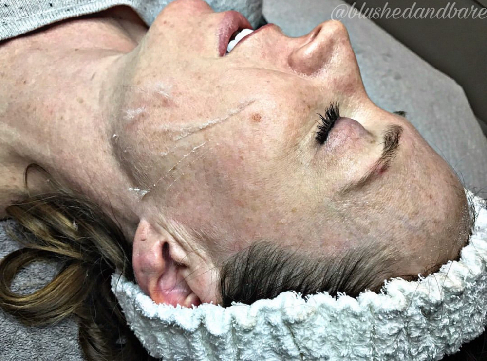 Dermaplane Facial