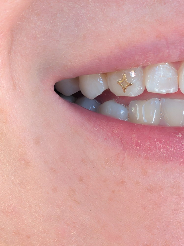 1 Gold Tooth Gem Application