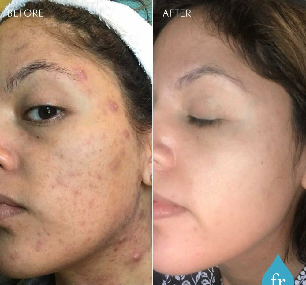 Acne BootcampFaceReality Clear Skin