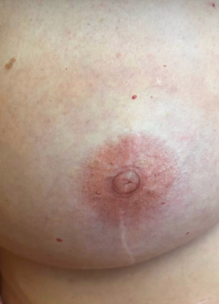 3D Nipple + Areola Repigmentation