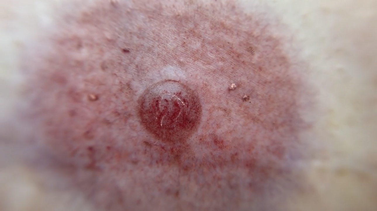 Areola Repigmentation