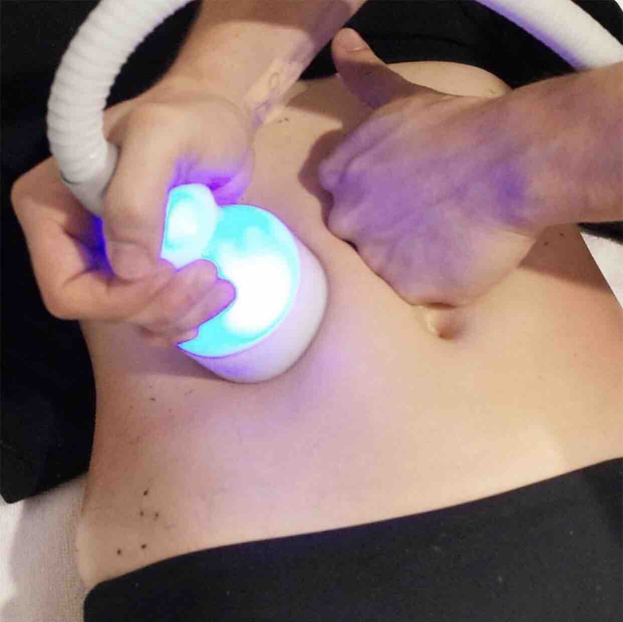 5 Cryoskin Fat Freezing Sessions
