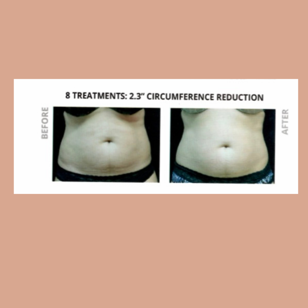 Viora Stomach at Aesthetics By Melanie in Portland, OR