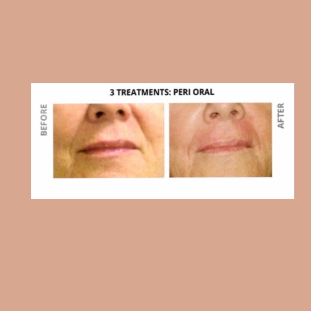 Skin Tightening- Lower Face/ Jowls