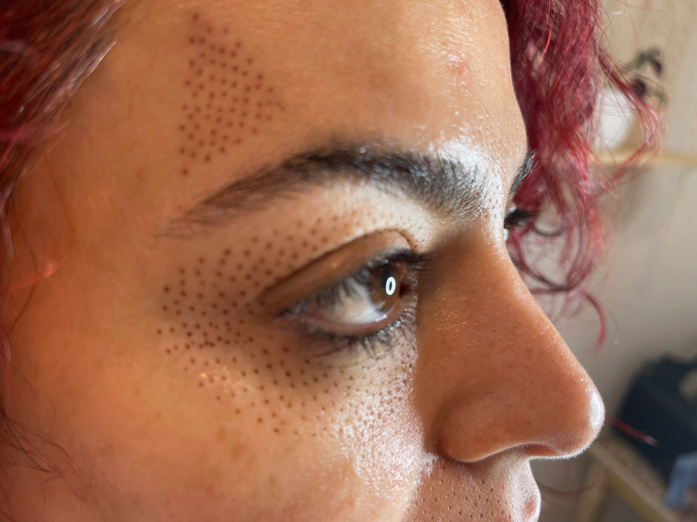 Eyebrow Lift (mini Or full)