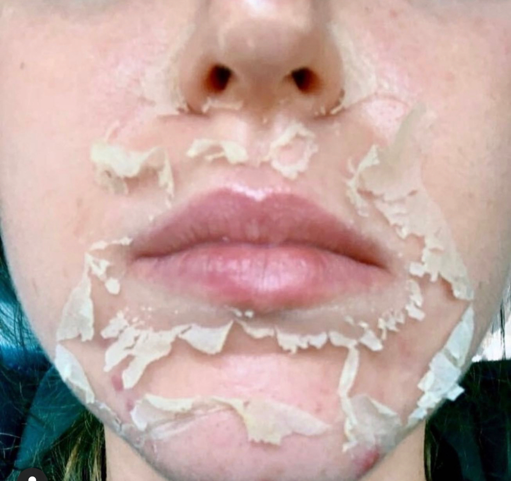 Perfect Derma Peel