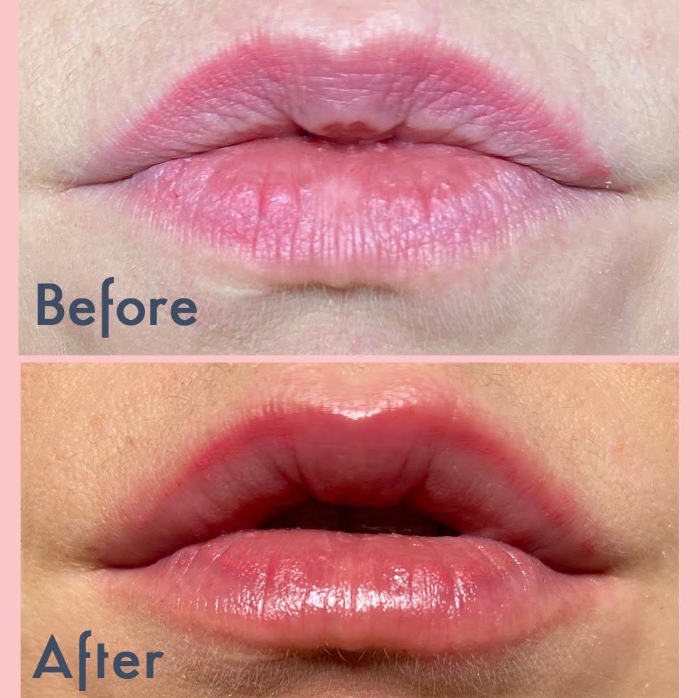 Lip Plumping Treatment