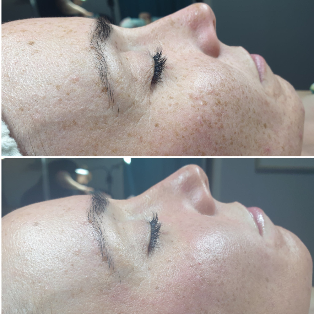 Lightening Lift at Genie of Skin in Mooresville, NC