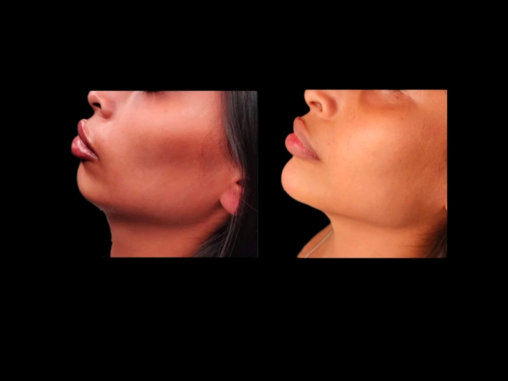 Chin Filler at Pin Me Aesthetics PLLC in Alvin, TX