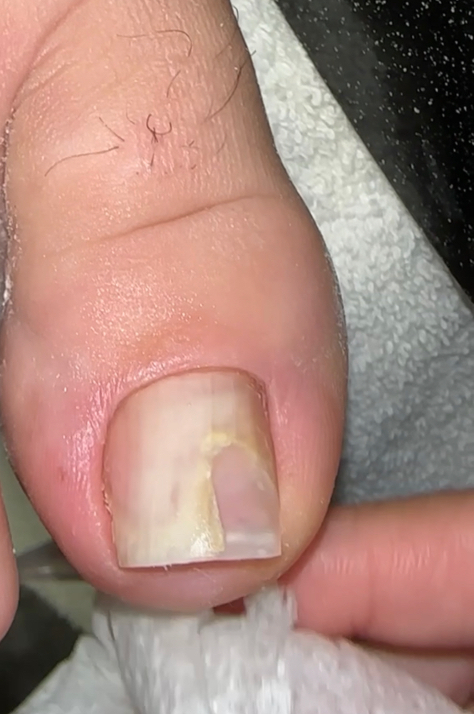 Toe Nail Repair Per Nail Add-on