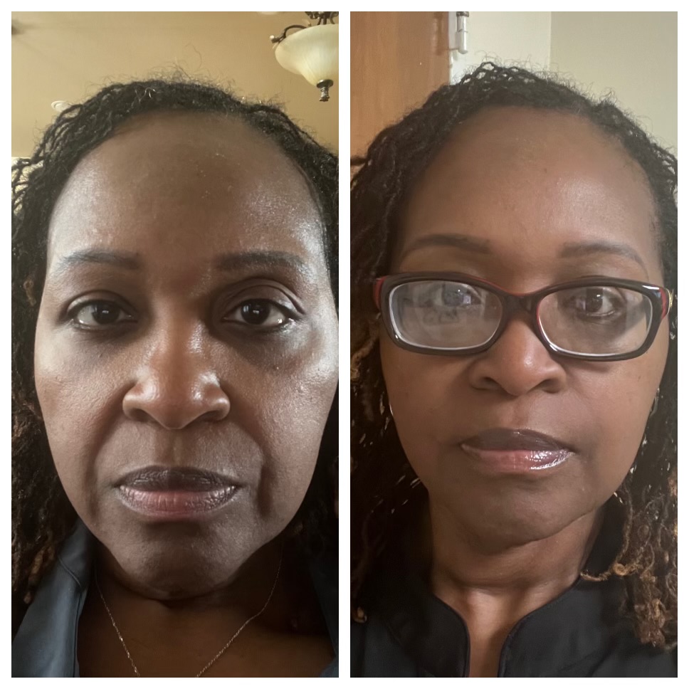 SMILE LINE (NASO LABIAL) FILLER
