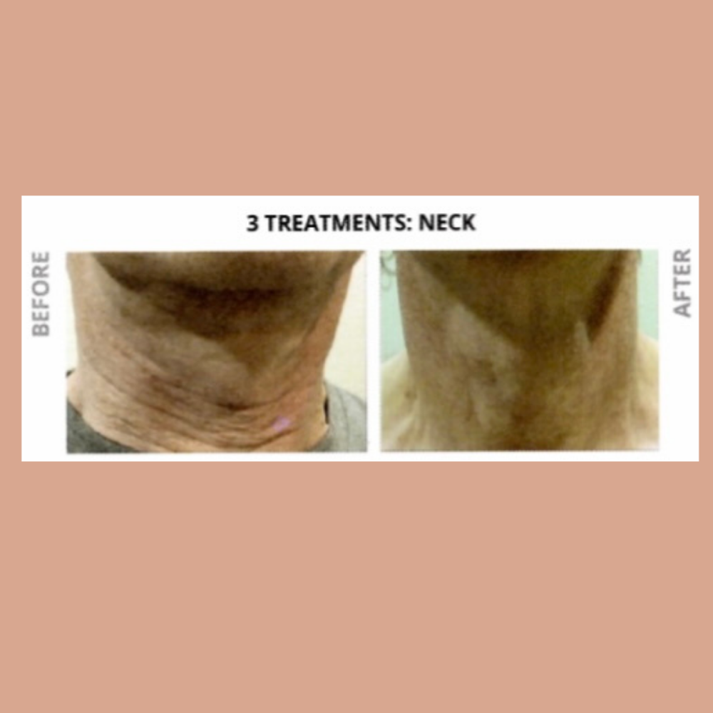 Laser Resurfacing- Neck