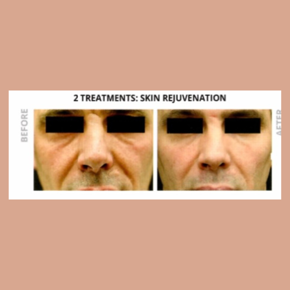 Laser Resurfacing-Hand/knees/eblows